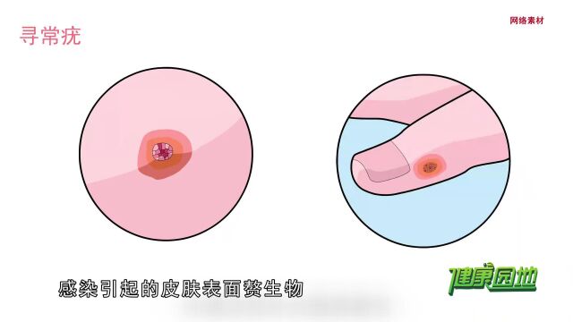 健康园地6.22 有一种疣叫寻常疣