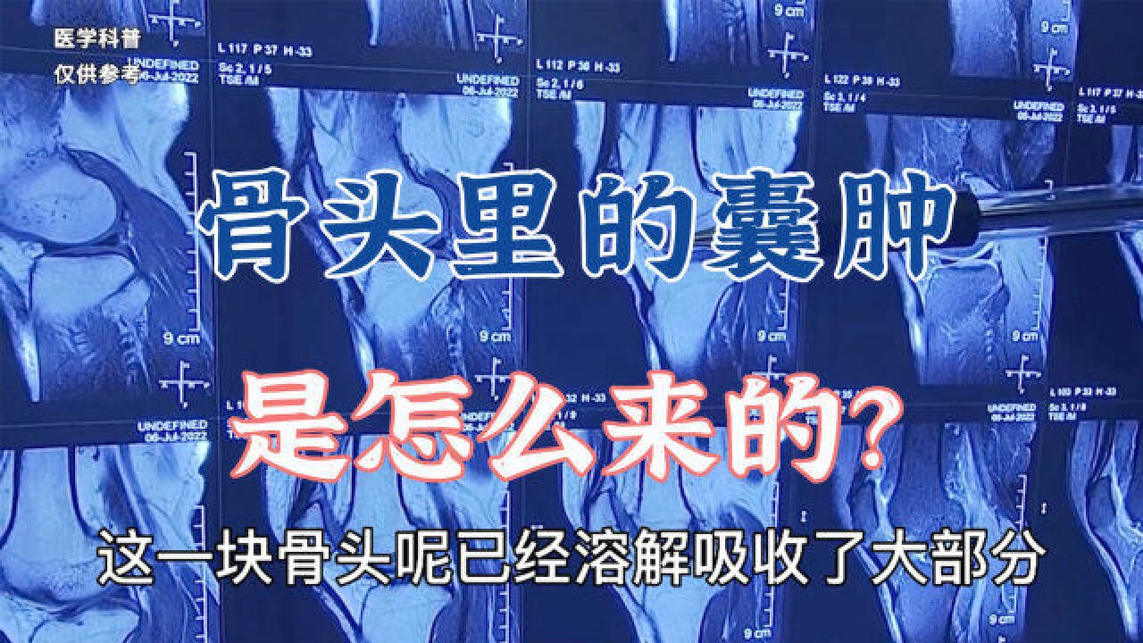 为什么骨头里会出现囊肿?囊肿是怎么来的?肖教授分析病例讲解