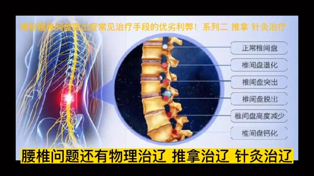 腰椎间盘突出的常规治疗优劣利弊 系列二 推拿 针灸 治疗 