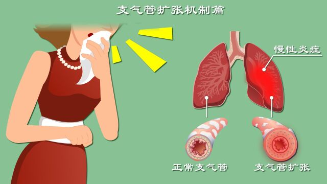 支气管扩张咋回事?反复咳嗽背后真相是啥?硬核科普支扩发病机制! 