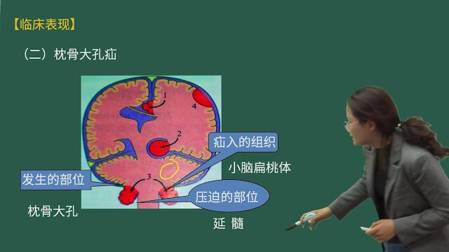 外科护理(高级)考点透析颅内压增高及脑疝病人的护理脑疝