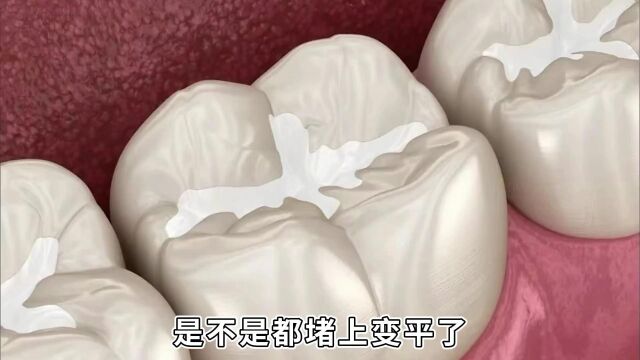 窝沟封闭全过程演示