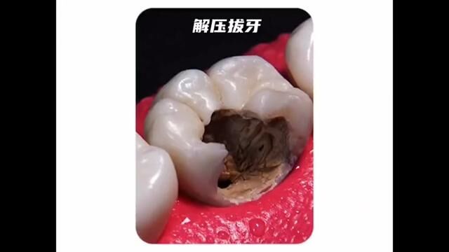 根管治疗!