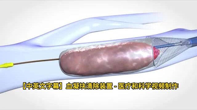 【中英文字幕】血凝块清除装置  医疗和科学视频制作