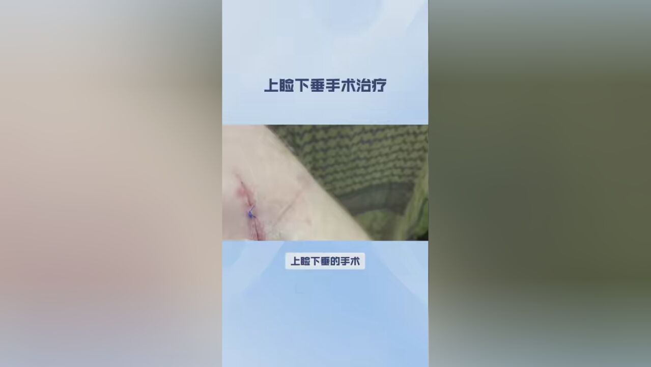 第31集|上睑下垂的手术治疗 #上睑下垂