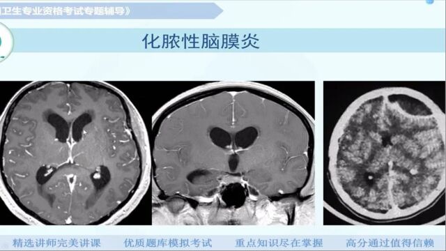 【放射医学(中级)】第八章神经系统及头颈部:颅内感染