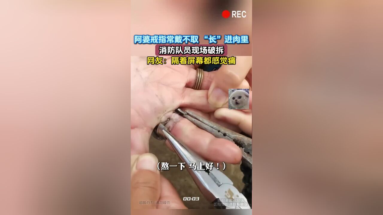 阿婆戒指常戴不取 “长”进肉里,消防队员现场破拆