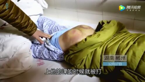 【腾讯视频】 小学生没有完成作业 被老师用棍子打 屁股肿得像包子