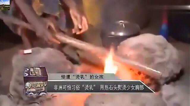 非洲可怕的“烫乳”习俗 这样残忍的做法只是为了怕被男人性侵