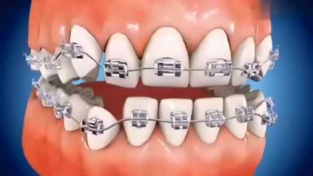 牙齿地包天真的很难看,3D演示地包天的矫正,为了好看再疼也要忍!