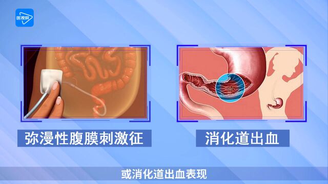 第23节:腹腔和后腹腔器官缺血性疾病的鉴别诊断提示