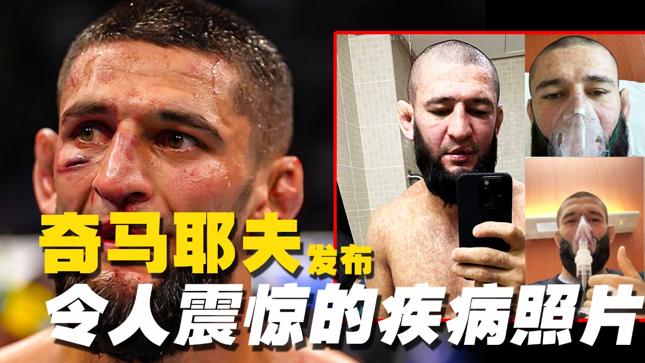 UFC奇马耶夫发布令人震惊的疾病照片,透露“我病的很重”