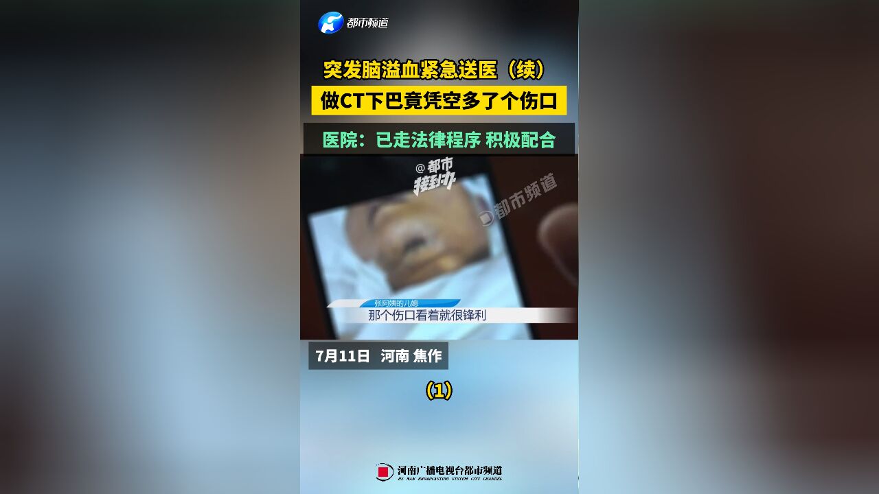 突发脑溢血紧急送医(续),做CT下巴竟凭空多了个伤口,医院:已走法律程序(1)