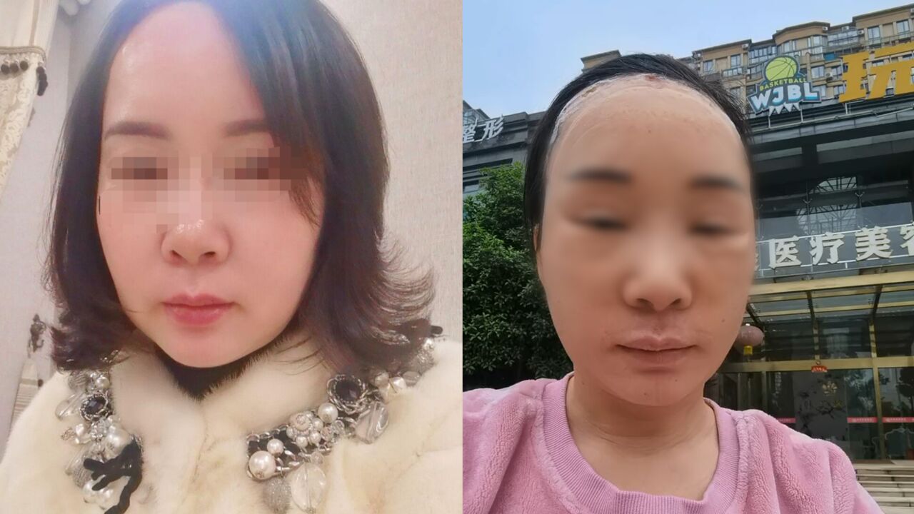 女子称做拉皮手术致额头皮肤坏死,前后容貌相差巨大,医美机构:已报警