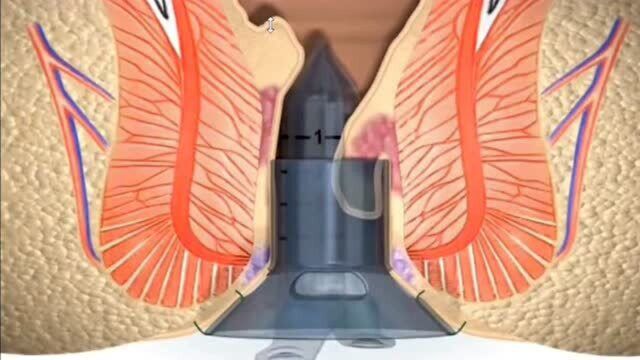 很多人都不敢做痔疮手术,3D动画演示手术过程,其实并没有那么可怕!