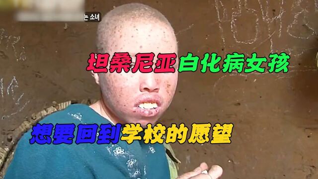 坦桑尼亚白化病女孩,想要回到学校的愿望