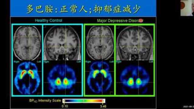 解开对精神类疾病的迷思 3