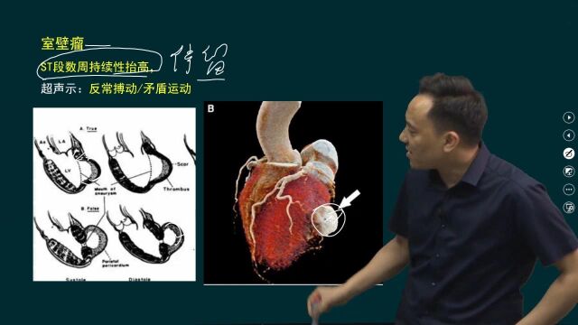 04.冠状动脉性心脏病