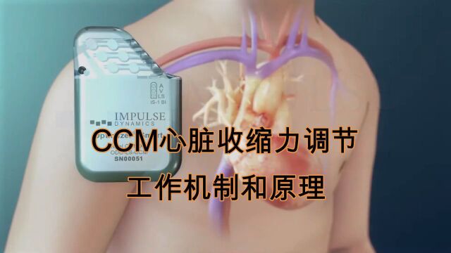 心衰新器械:CCM的原理和机制