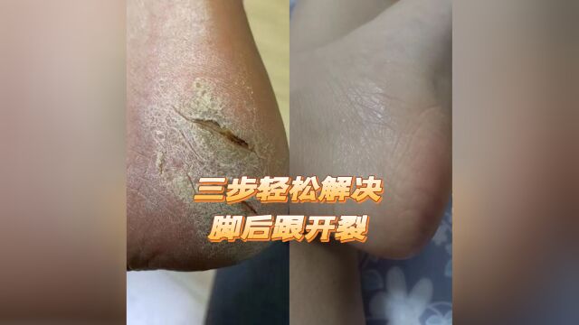 手脚干裂蜕皮很难看?学会这几招,轻松解决裂口!