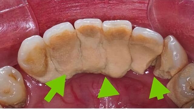曝光三款国货牙粉!牙结石在家一刷成片掉落!再也不用去洗牙了!