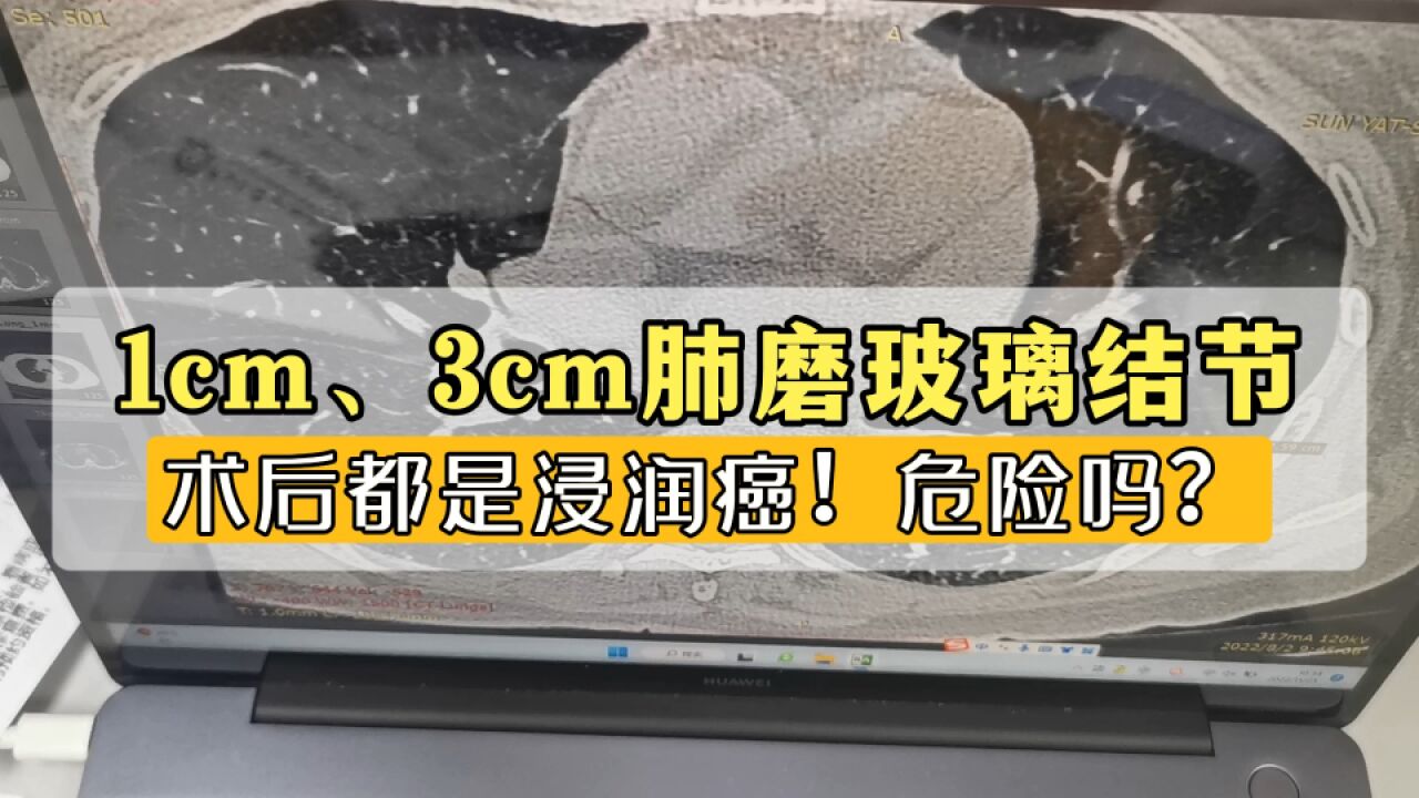 肺内1cm、3cm肺磨玻璃结节,术后都是浸润癌!依旧安全吗?