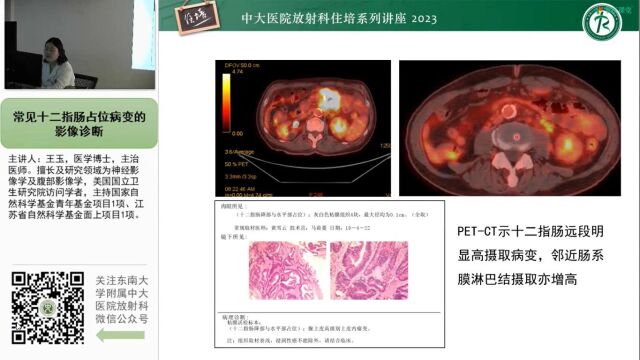 常见十二指肠占位影像诊断中大王玉