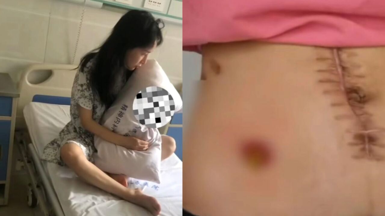 遭家暴16次女子公开挂粪袋造口画面:排一次皮肤就腐蚀一次,剧痛