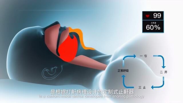 黑格科技德雅DSN定制式止鼾器——宣传篇