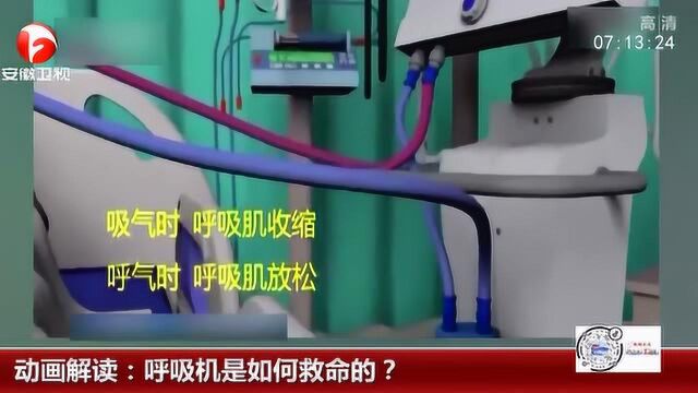 呼吸机是如何救命的?帮助患者挺过呼吸衰竭 对于新冠肺炎重症患者作用重大