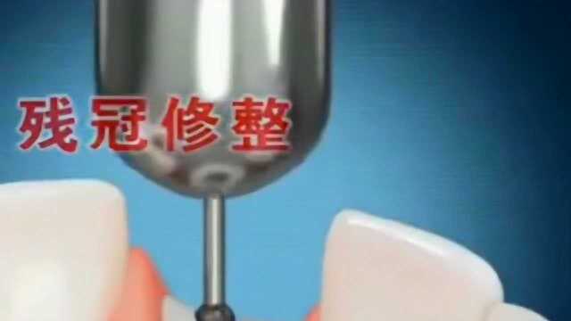 3D动画演示门牙牙冠如何修复,让你清晰了解牙齿,自己又学到了