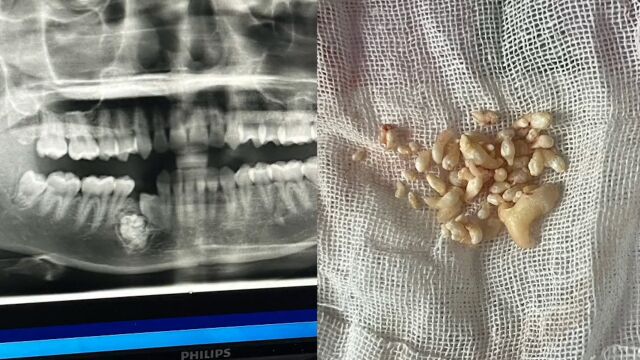 23岁女孩缺1颗牙10多年被确诊牙瘤,手术拔出57颗牙,医生:一般不会癌变