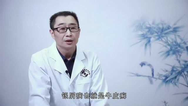 医生有你:怎样辨别头癣和头部牛皮癣?