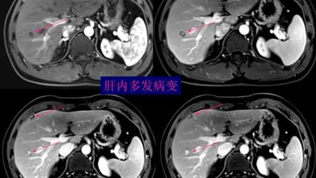 肝脏良恶性病变的诊断及鉴别诊断