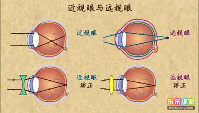 科普:近视眼与远视眼的区别!