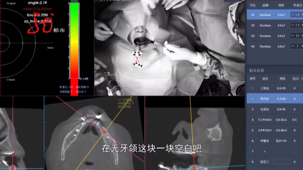 东北首例 机器人辅助无牙颌种植