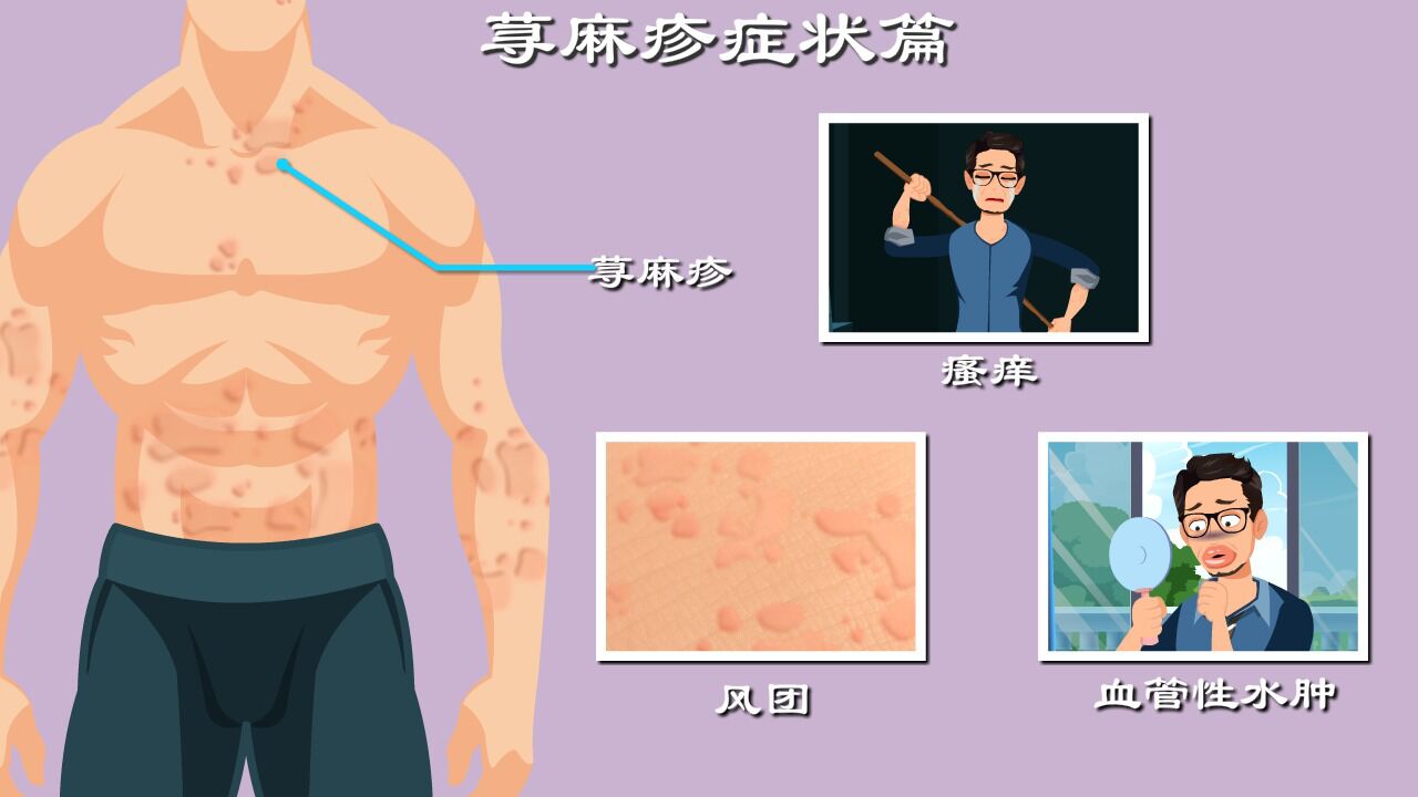 风团、瘙痒?我国20%的人发作过荨麻疹?春天来了,这些症状要小心!