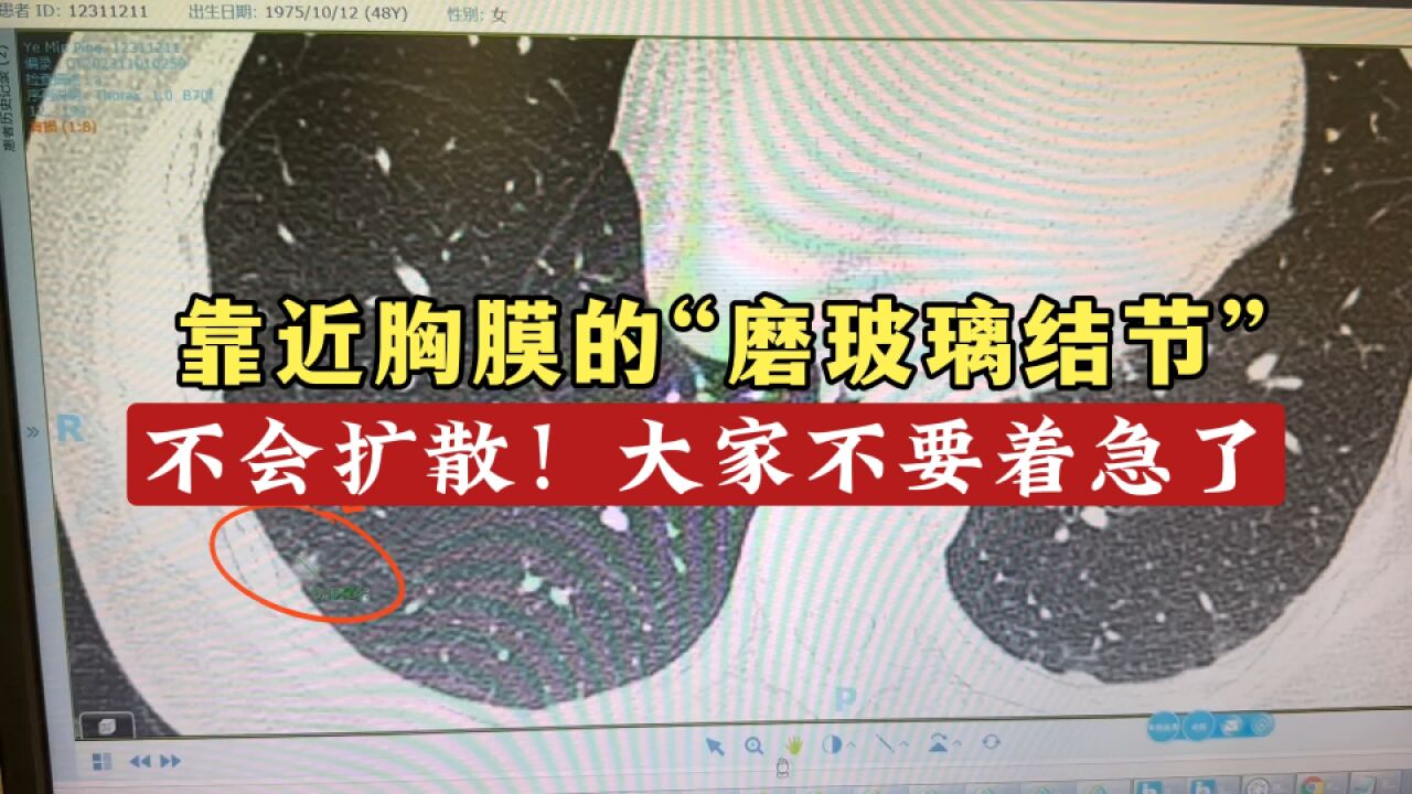 大家不要着急!靠近胸膜的“磨玻璃结节”,我至今没看过扩散的