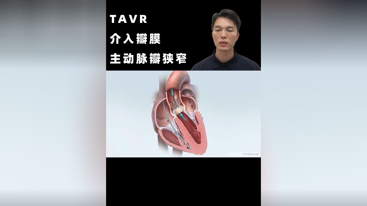 TAVR介入瓣膜手术:治疗主动脉瓣狭窄