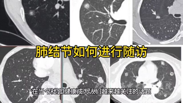 筛查出的肺结节如何进行随访