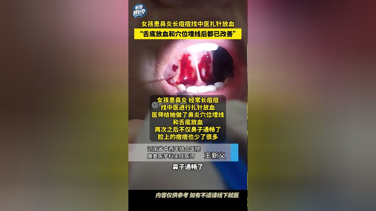 女孩患鼻炎长痘痘找中医扎针放血“舌底放血和穴位埋线后都已改善”