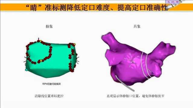 华医心诚讲堂:房颤消融中射频导管的应用及其有效性和安全性考量