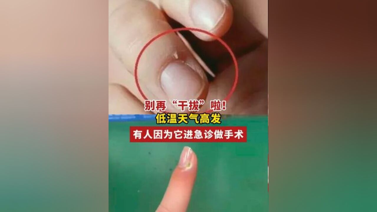 对于倒刺,你是怎么处理的?还是不要干拔了啊!