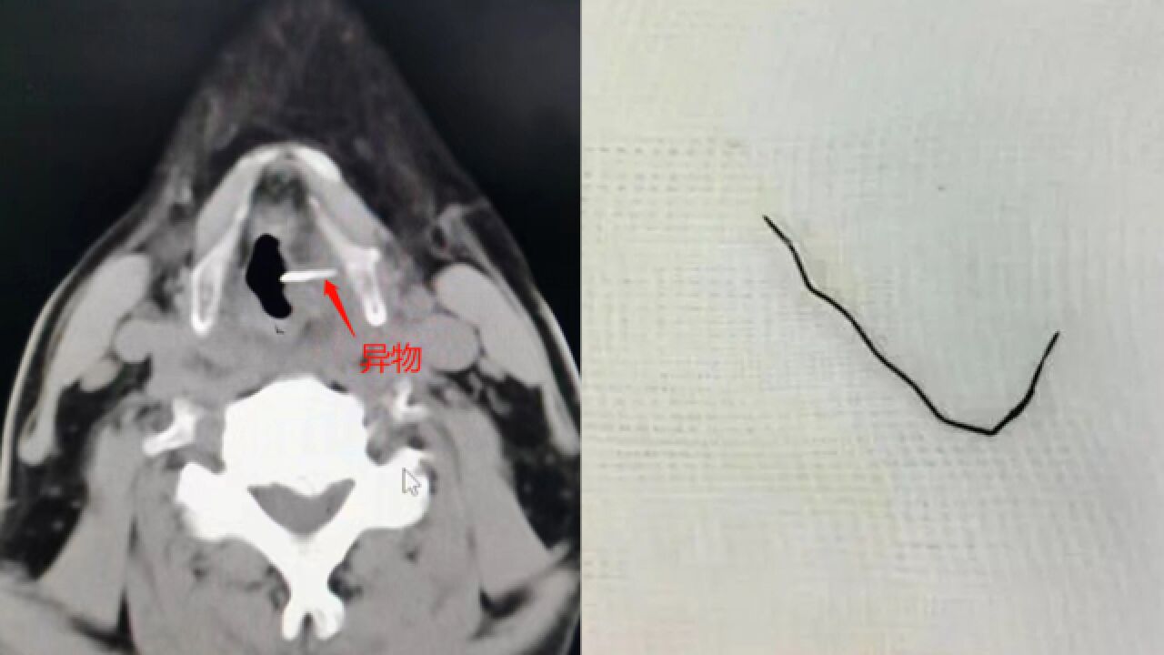 男子吞3厘米铁丝1个月后才知道:以为患癌就医,查出喉咙有铁丝