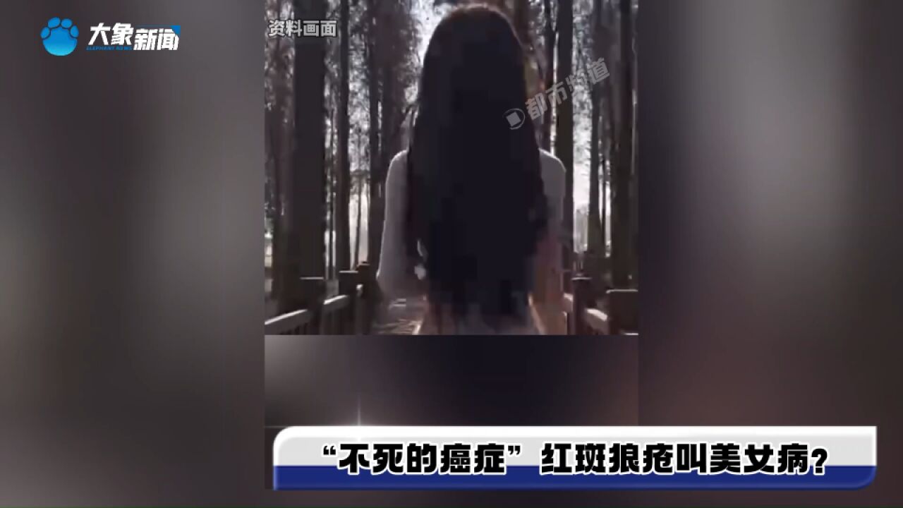 “不死的癌症”红斑狼疮叫美女病?研究表示:高发人群是年轻女性