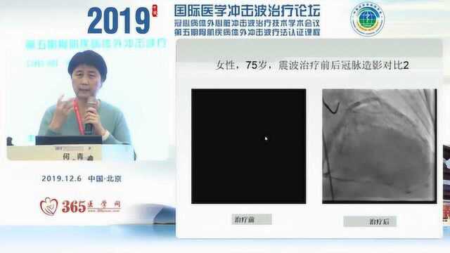 北京医院何青教授视频:冲击波技术在冠心病治疗中的临床应用