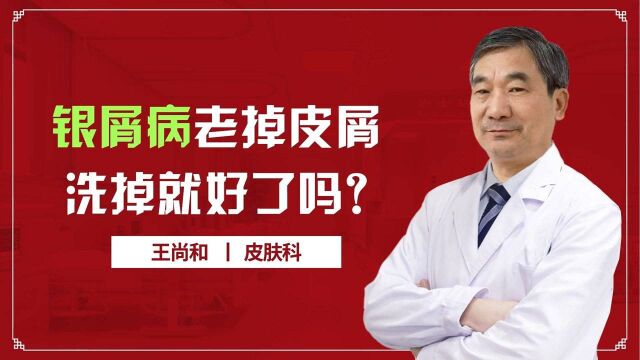 银屑病老掉皮屑,洗掉就可以了吗?