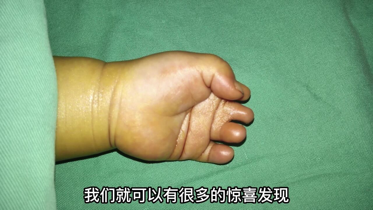 并指免植皮 第6集《孩子波兰综合征并指,手术做的早,术后外形和功能恢复良好》