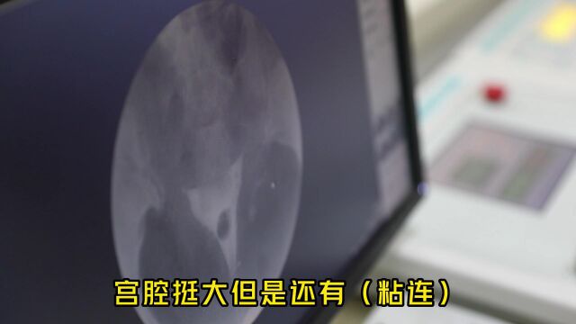 输卵管造影检查|查明不孕原因,才能精准治疗—温州治疗不孕不育的医院