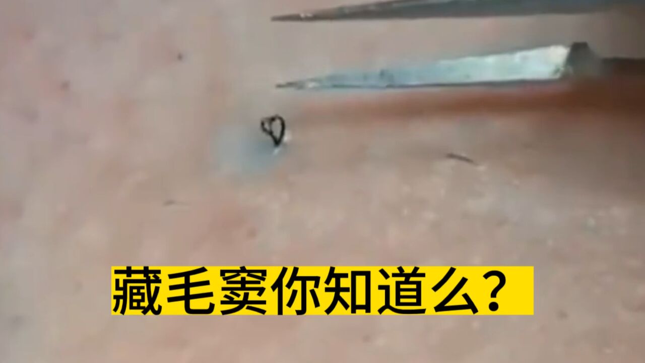 藏毛窦你知道么?